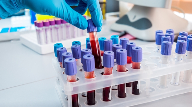 新的血液测试可以更早地检测出脑癌 ,stylechina.com