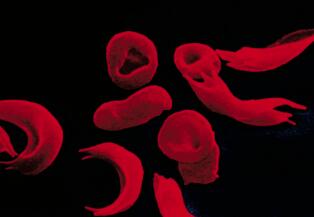 pipeline.jpg 两种新药有助于缓解镰状细胞病。但是谁来付钱呢? ,stylechina.com