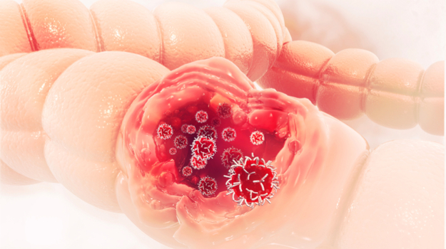 对结直肠癌的新见解可能会导致新疗法 ,stylechina.com