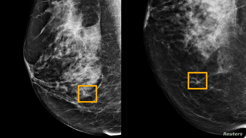 研究发现Google系统可以改善乳腺癌的检测 ,stylechina.com