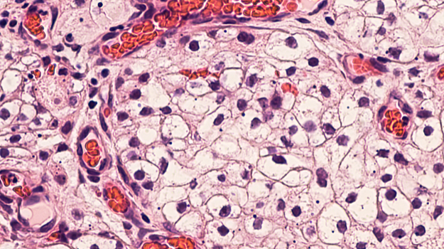 BMS发布接受Opdivo和Yervoy治疗的RCC患者的长期长期阳性数据 ,stylechina.com