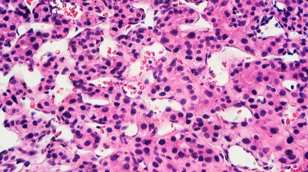 Opdivo和Yervoy组合赢得了HCC的加速批准 ,stylechina.com