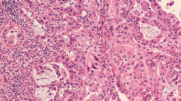 随着大流行的继续，拉斐尔制药公司将患者纳入第三期胰腺癌试验 ,stylechina.com