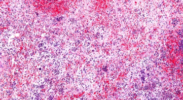 Imago BioSciences推进骨髓纤维化试验,IIb期预读出迫在眉睫 ,stylechina.com