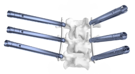 CoreLink通过Tiger MIS扩展式椎弓根椎弓根螺钉系统扩展了微创产品系列 中网时尚,stylechina.com