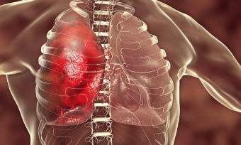 罗氏Actemra在三期COVID-19关联性肺炎研究中未获认可 中网时尚,stylechina.com