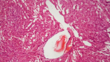 Intellia旨在通过CRISPR治疗治愈ATTR 中网时尚,stylechina.com