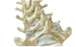 ZygoFix完成200万美元的融资并在以色列启动一项新的临床研究 中网时尚,stylechina.com