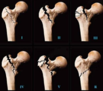 有远见的骨损伤研究：X射线证实了新的发光标记物的前景 中网时尚,stylechina.com