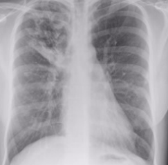 使用尿液挥发性有机化合物区分结核病患者与健康受试者 中网时尚,stylechina.com