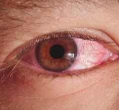 它会导致发红，疼痛，流泪，并可能使视力下降数月 中网时尚,stylechina.com