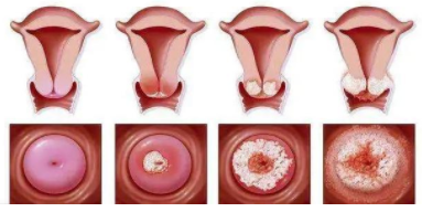新兴技术可能有助于检测导致宫颈癌低收入国家和发展中国家的病毒 中网时尚,stylechina.com