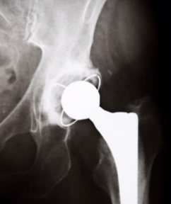 使用HPMA共聚物共轭物在小鼠颅骨骨溶解模型中早期发现和治疗磨损颗粒引起的炎症和骨质流失 中网时尚,stylechina.com