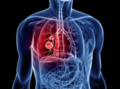 作为潜在的肺癌生物标志物的SAA的鉴定和验证及其在肺癌转移发病机制中的作用 中网时尚,stylechina.com