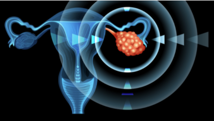 ASCO：在靶标制造的荧光标记上增加卵巢癌手术的机会 中网时尚,stylechina.com