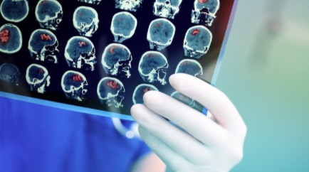 脐带蛋白可以提高中风存活率和恢复率 中网时尚,stylechina.com