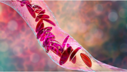 细胞和基因疗法：平衡镰状细胞疗法的希望与承诺 中网时尚,stylechina.com