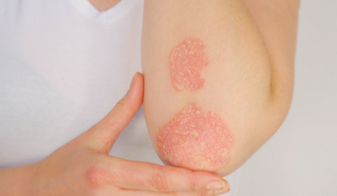 银屑病关节炎、狼疮的阳性数据在 EULAR 上发表 中网时尚,stylechina.com